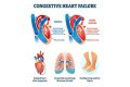Heart Failure And The Plight Of Extreme Obesity